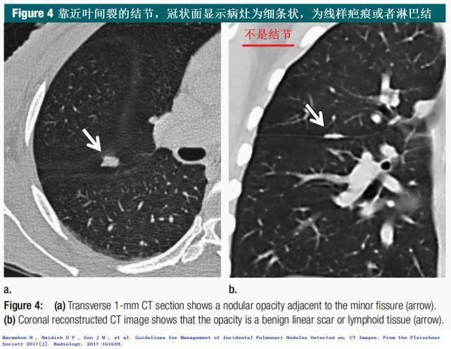  结节|肺结节切还是不切？20张经典图谱说明白了！