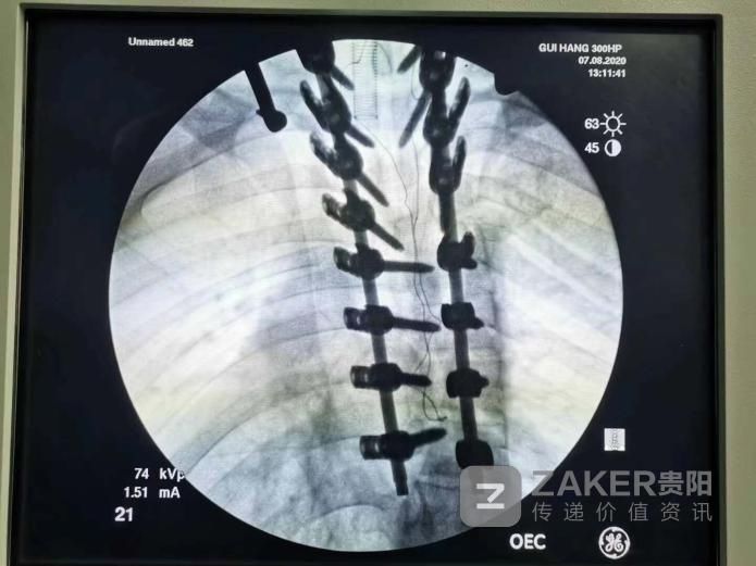  变形|22岁小伙“驼背”十余年 医生植入螺钉重塑变形脊柱