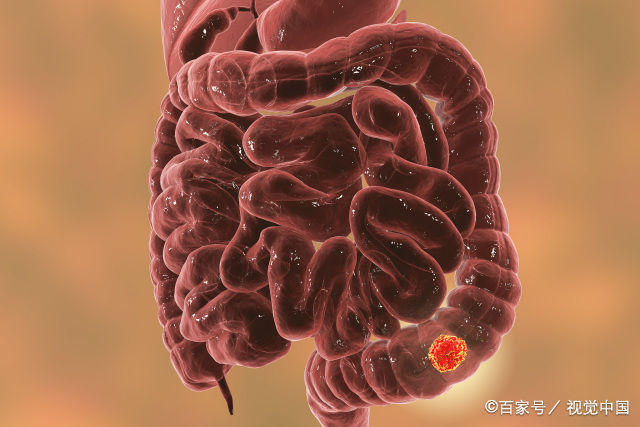 肠息肉的饮食应该主要注意什么(肠息肉不想变肠癌，饮食有哪些注意事项？)