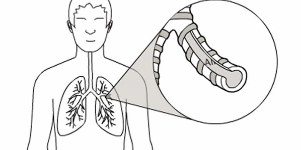  根治|浙江大妈清理车库时突然呼吸困难！一查竟得了…医生：很难根治