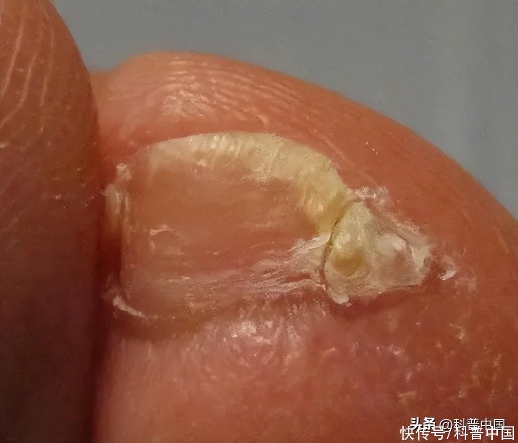小脚趾指甲分两瓣是什么说法(小脚趾指甲分成两瓣的人，到底是什么来历？)