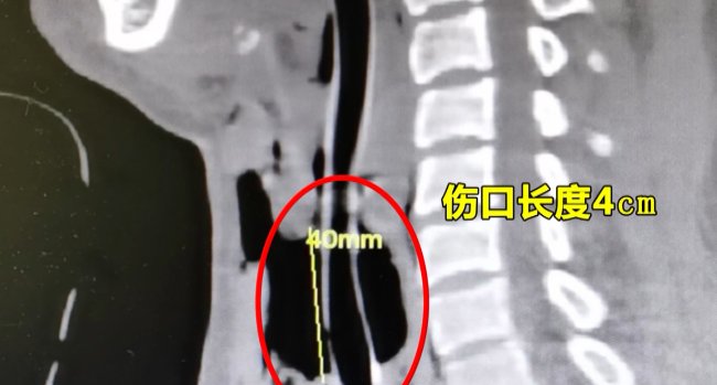  割破|杭州一女子骑电瓶车时突遭勒颈，气管被割破，“凶手”是谁？！