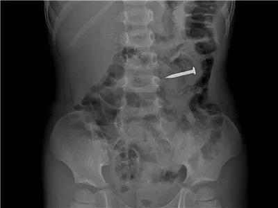  真相|有图有真相：那些年，孩子体内发现的硬币、钥匙、钉子、别针、电池……