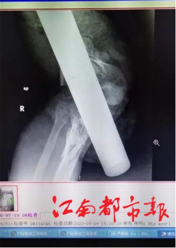  肢体|悲剧！小伙上个厕所，人差点没了！