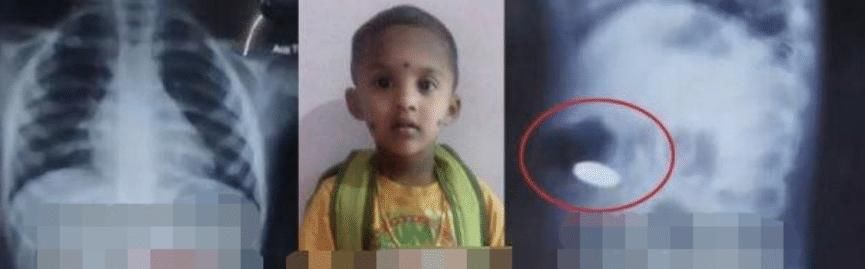  误吞|印度3岁男孩误吞硬币，被三家医院拒收后，回家吃水果当晚暴毙！