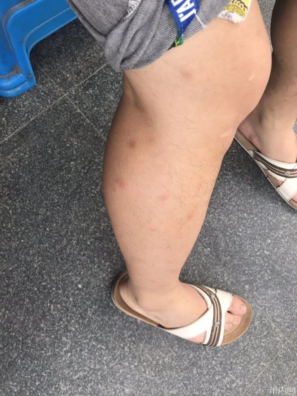  湘湖|杭州小伙去湘湖走了一圈，双腿被咬成这样！最近多人中招