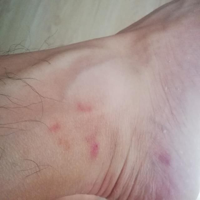 小心|在海边被咬,数天后仍旧奇痒难忍!夏季要小心它