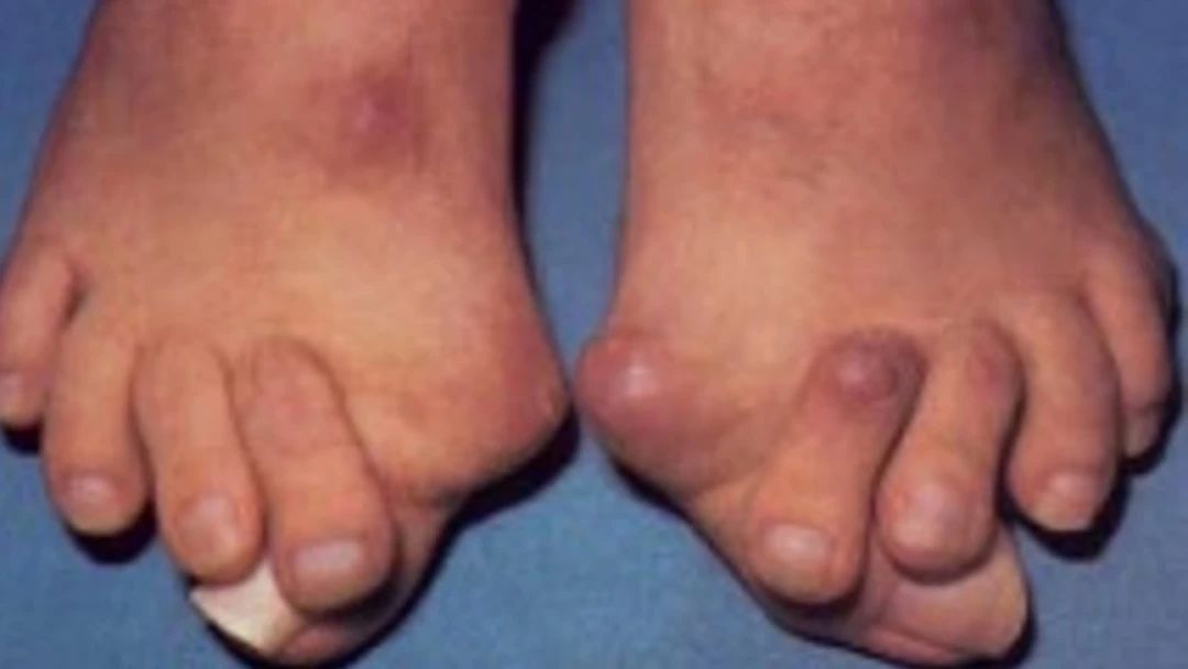  类风湿|风湿与类风湿有什么区别？类风湿的典型症状