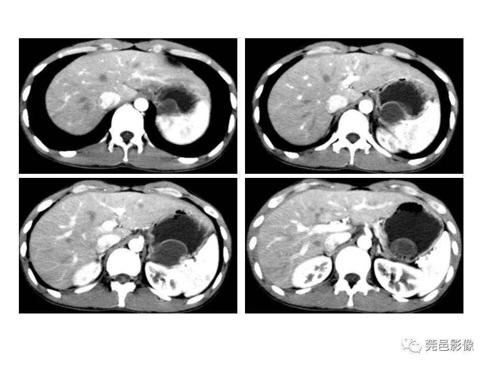 畸形|胃重复畸形CT诊断与鉴别诊断