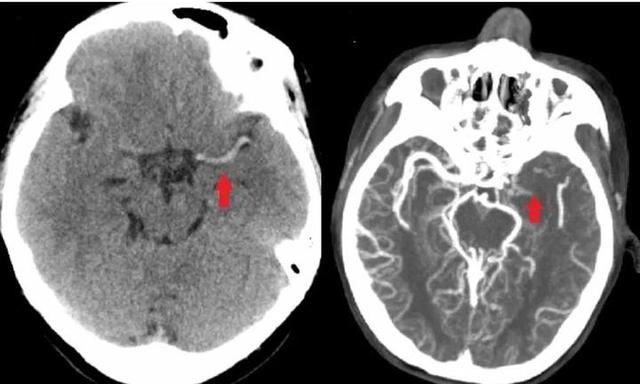  半身不遂|31岁年轻妈妈突发半身不遂 医生还原可怕的家庭真相