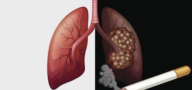 肺部|肺部的清洁工现身了，排出堆积的烟毒，连呼吸也轻松了