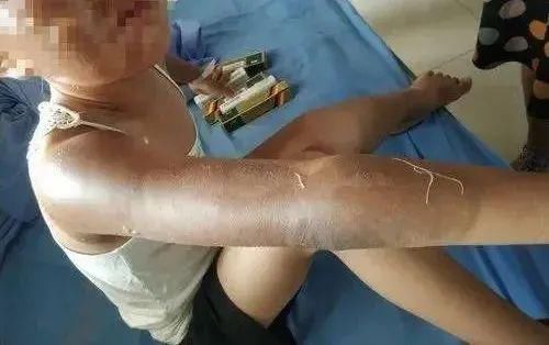  气球|这款常见玩具突然爆炸！7人被烧伤！提醒：已上“黑名单”