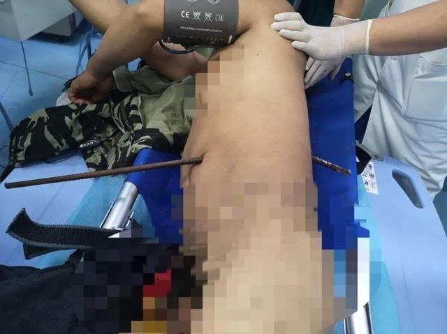  救联动中心|院线播报｜惊心动魄！钢筋插入工友腹部，国壮成功取出