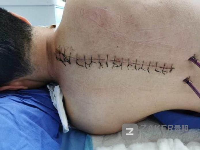  变形|22岁小伙“驼背”十余年 医生植入螺钉重塑变形脊柱