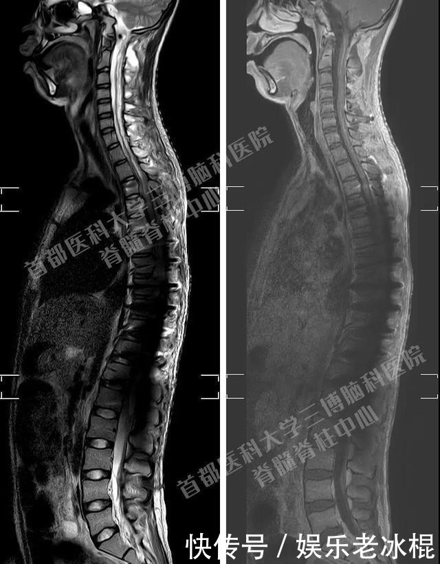 脊髓|非常罕见 15岁初中生莫名肢体无力 脊髓内竟然长满肿瘤