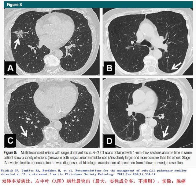  结节|肺结节切还是不切？20张经典图谱说明白了！