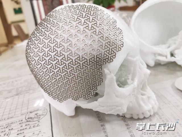  帅小伙|22岁帅小伙遭车祸多处骨折致毁容，湘雅多学科专家用3D打印技术一次性助其恢复原貌