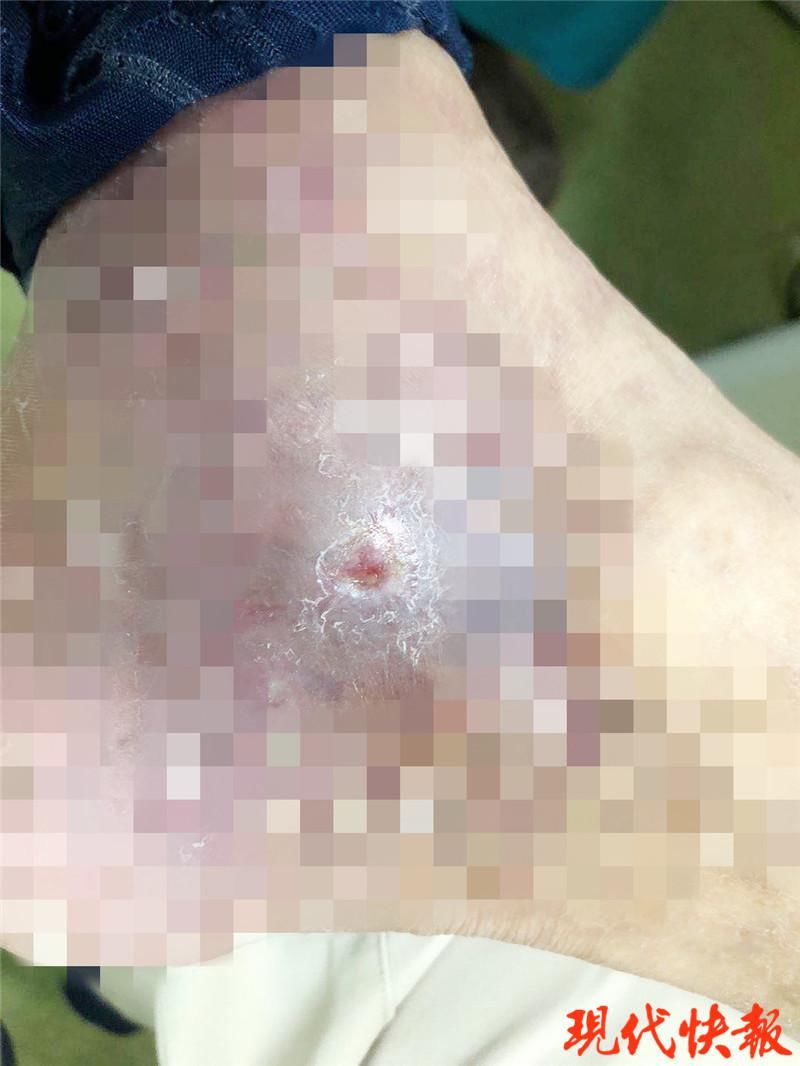 左脚踝内侧|男子脚踝蹭掉一块皮,治了5年才治好