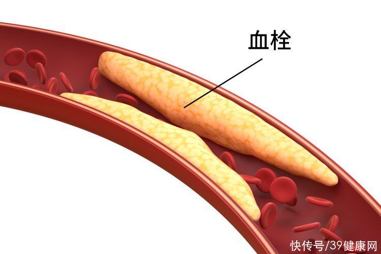 血栓来临手脚先知的四个症状(血栓来临，手脚先知！提醒：手脚出现4种表现，或提示你血管堵了)