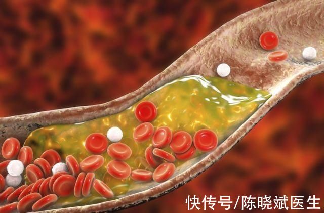 高血脂适合吃哪些粗粮(联合呼吁:这1种“粗粮”，或是高血脂的“帮凶”!平时不吃也罢)