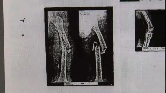  就医|肇事逃逸后“人间蒸发”16年，一条就医记录暴露其踪迹……