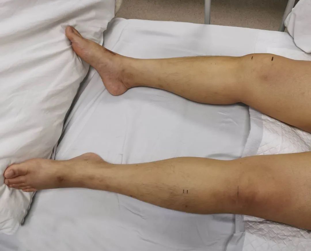  剧毒|珠海女子喝了这个东西，身中剧毒！进ICU 22天后…