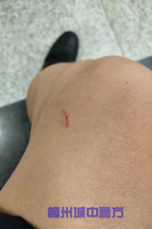 女子|拘!一女子遛狗不牵绳还纵狗咬伤辅警