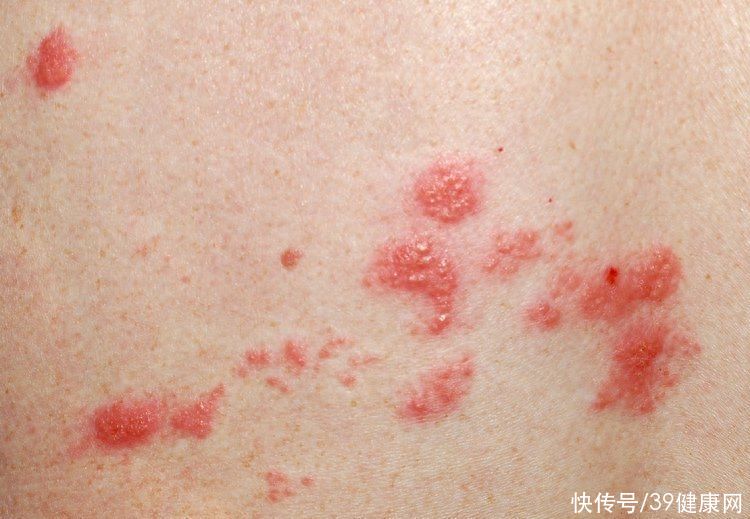 甲钴胺对糖尿病人要吃多久才有效(甲钴胺是糖尿病患者的“好帮手”，对付5种病很在行，吃多久停药)