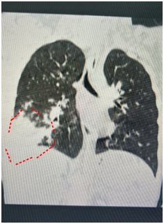 杭州7岁男孩咳嗽3周，一查肺部白了一片！最近小心这种肺炎！