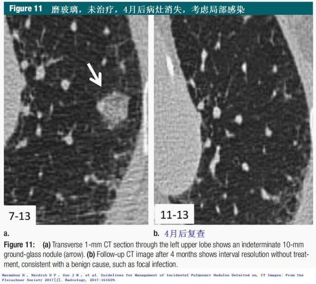  结节|肺结节切还是不切？20张经典图谱说明白了！