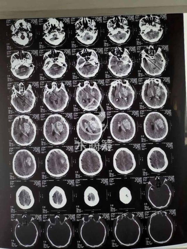  脑出血|求助：婆婆身体还没康复，公公脑出血又进了重症