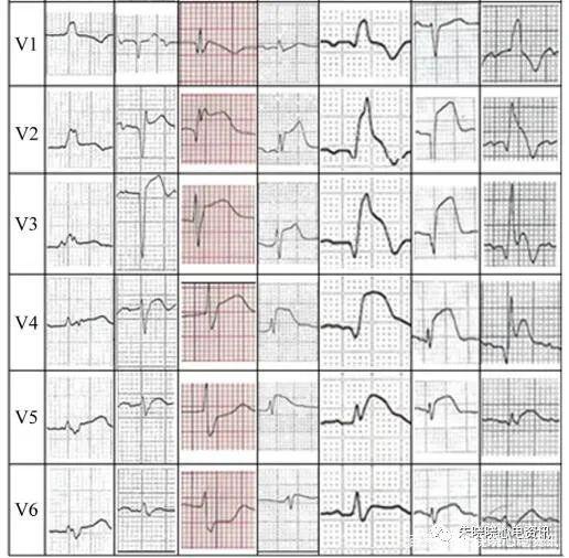 冠状动脉|左主干闭塞的心电图表现