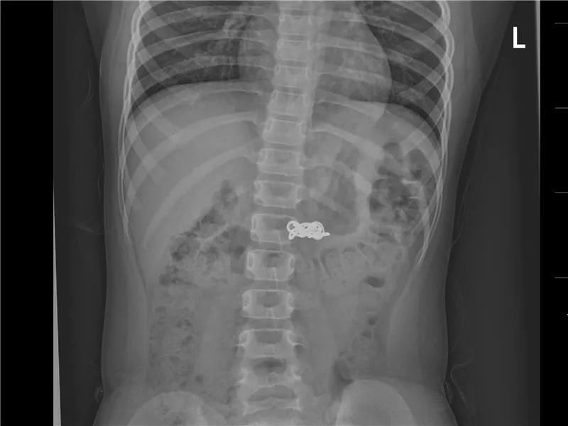  真相|有图有真相：那些年，孩子体内发现的硬币、钥匙、钉子、别针、电池……