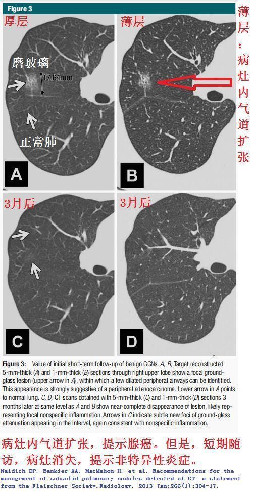  结节|肺结节切还是不切？20张经典图谱说明白了！