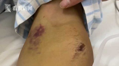 西安市中心医院|近期高发!小伙被它咬一口 脏器受损差点没命