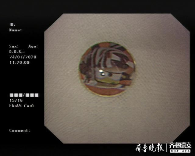 烟台山医院|小贴画也能引发大麻烦?烟台1岁半儿童误吞异物险酿大祸