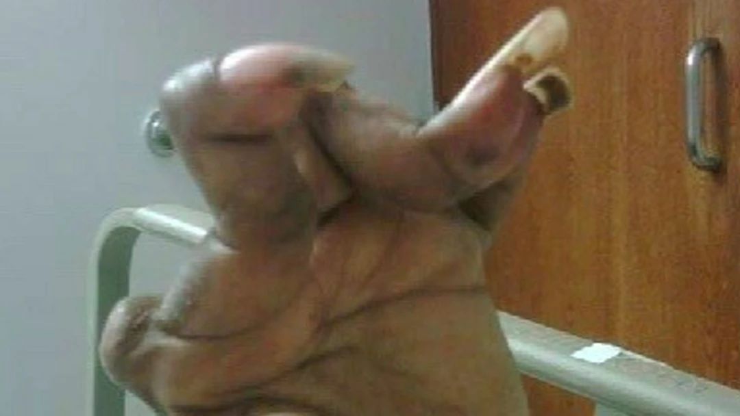  类风湿|风湿与类风湿有什么区别？类风湿的典型症状