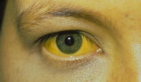  叹息|男子肝病晚期，痛哭流涕，叹息：面部早有迹象，只是被忽视了