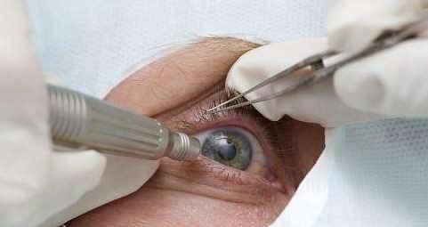 循环系统|白内障术后病情反复？医师说：术后补几种营养素可防复发