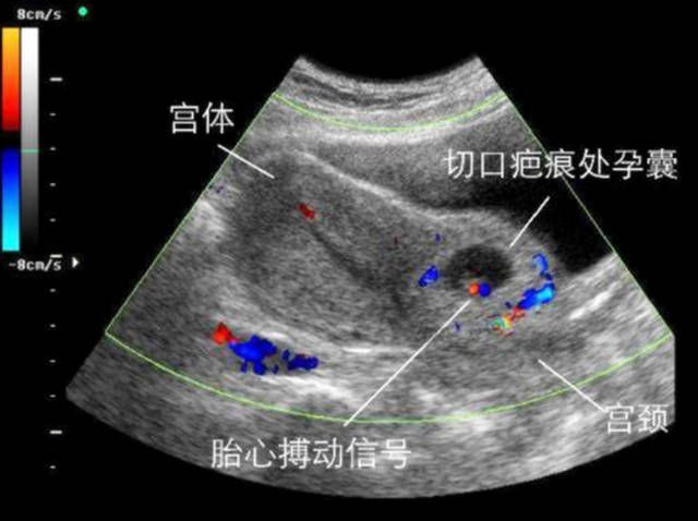  生二胎|头胎剖腹产，生二胎时可能面临这些风险，准妈妈心里要有数