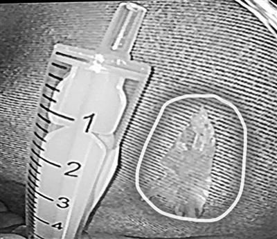  医院|吃鳊鱼不小心吞进一根骨头 徐女士连跑三家医院被送进手术室