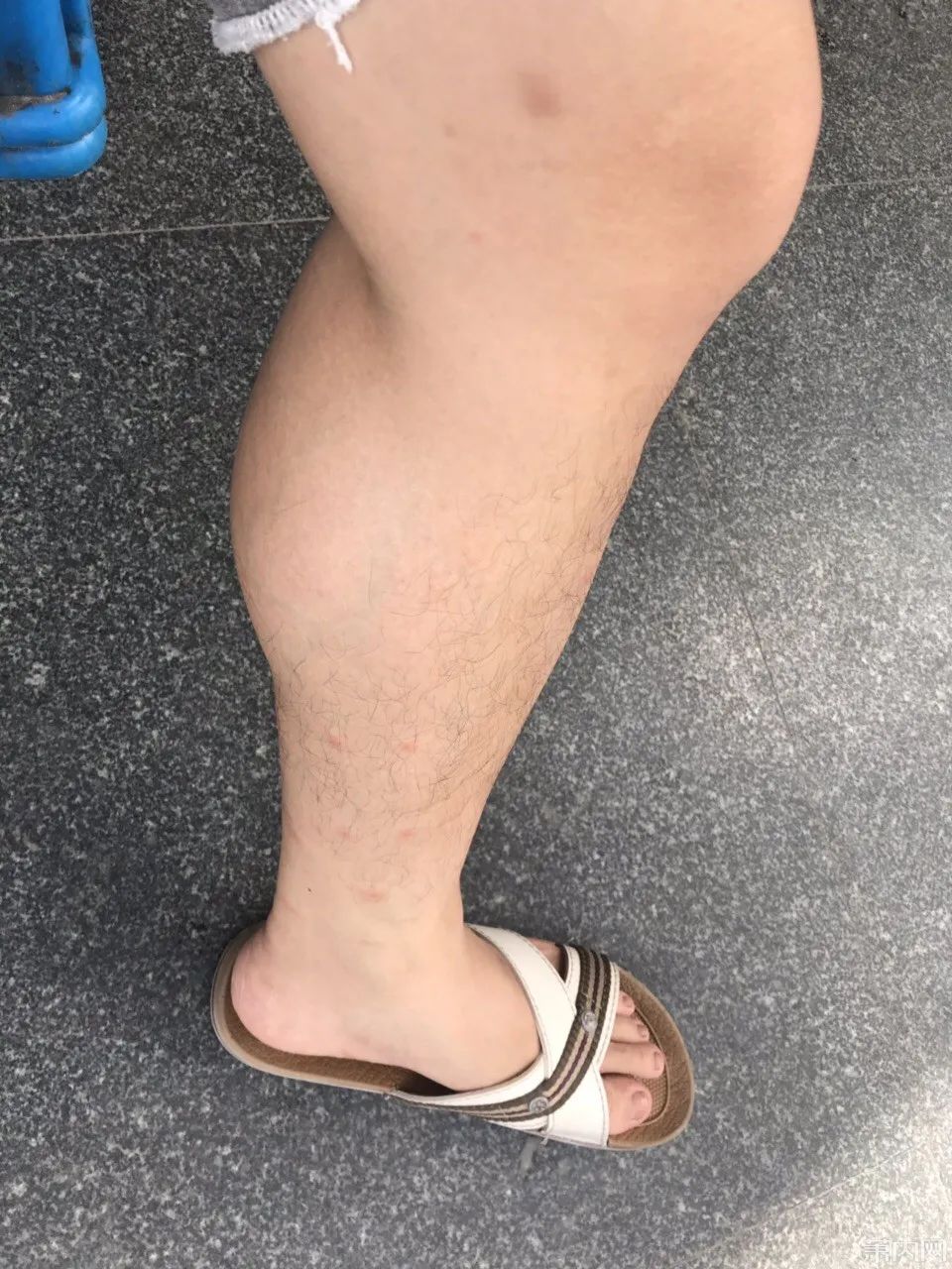  湘湖|杭州小伙去湘湖走了一圈，双腿被咬成这样！最近多人中招