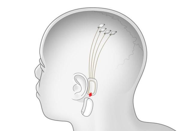  人脑|马斯克发布脑机接口：Neuralink无损植入猪脑，下一步植入人脑