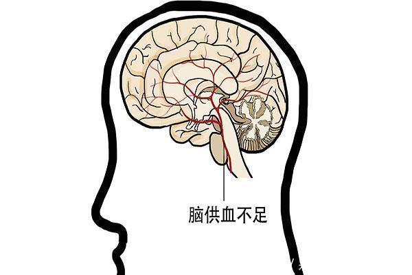  症状|脑梗发作跟什么有关发作症状是什么