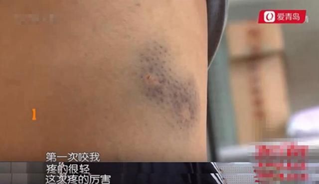  次被咬|女子俩月被狗咬两次，两只狗竟然是同一主人！狗主人：按倒霉处理