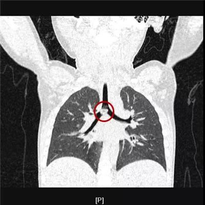  真相|有图有真相：那些年，孩子体内发现的硬币、钥匙、钉子、别针、电池……