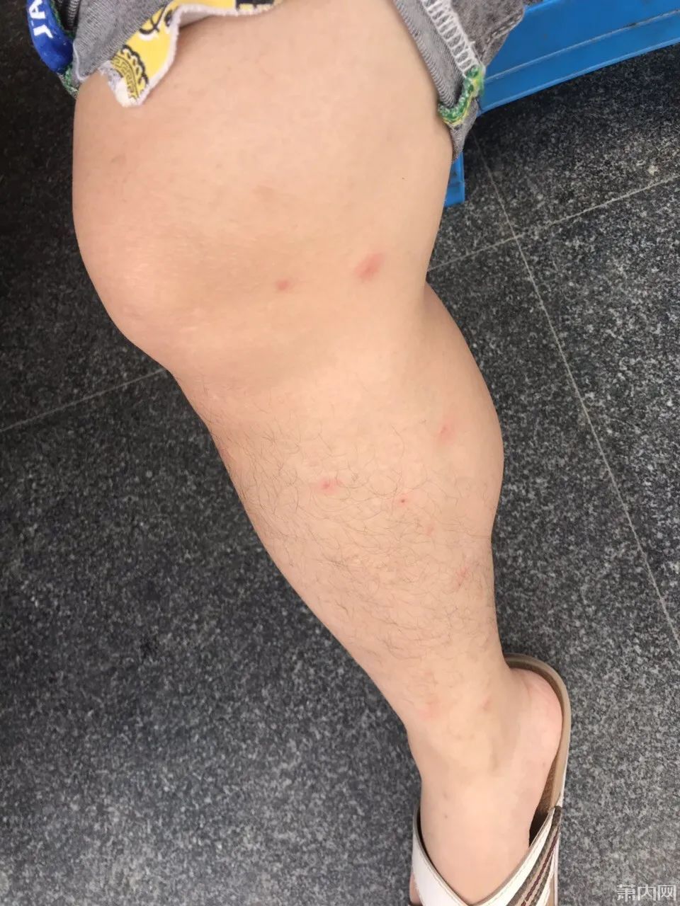  湘湖|杭州小伙去湘湖走了一圈，双腿被咬成这样！最近多人中招