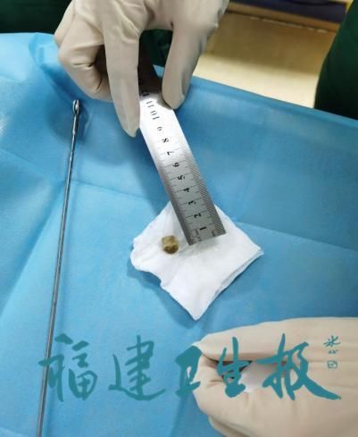 中山医院|男子胸闷气促两个多月，原来是支气管被猪骨头”塞住“了