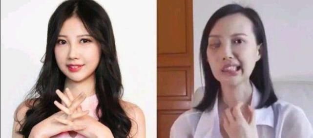 变形|歌手李明蔚抗癌已经8年，五官严重变形发视频筹款求助：我想活下去