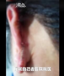  耳朵|男子街头阻止性侵被咬掉耳朵 无法修复只能开颅